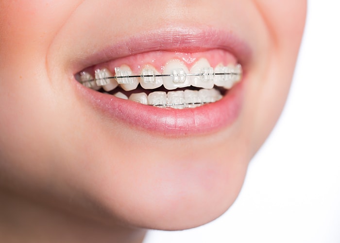 成人矯正で行う治療　イメージ画像