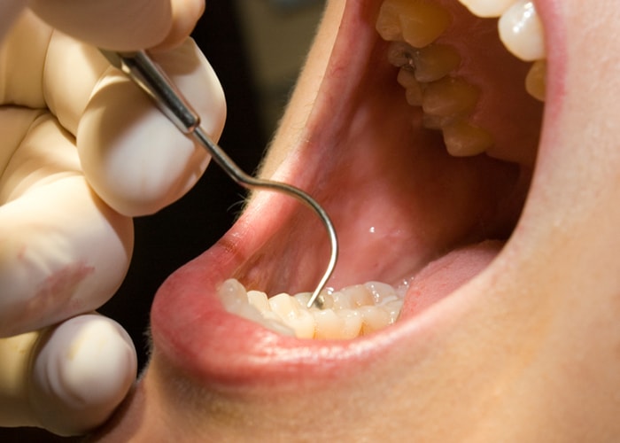 歯周病の原因 イメージ画像